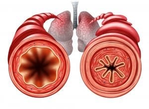 Exercice induced asthma